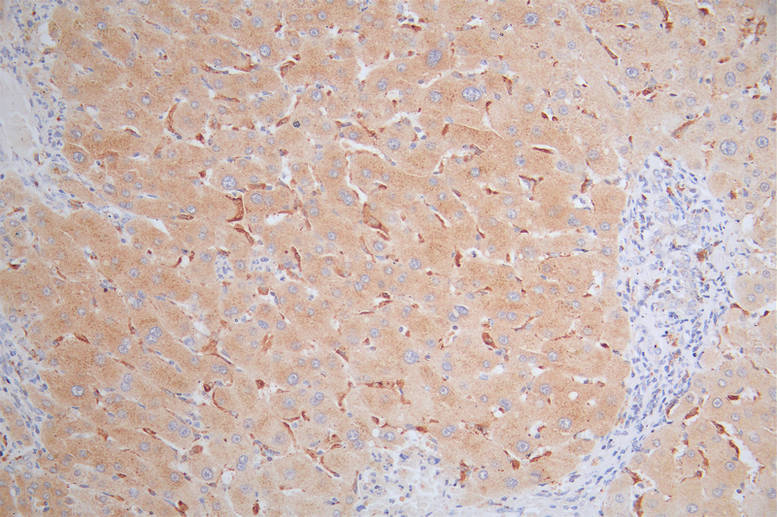 IHC image of RAC07518 diluted at 1:80 and staining in paraffin-embedded human liver cancer performed on a Leica BondTM system. After dewaxing and hydration, antigen retrieval was mediated by high pressure in a citrate buffer (pH 6.0). Section was blocked with 10% normal goat serum 30min at RT. Then primary antibody (1% BSA) was incubated at 4Â°C overnight. The primary is detected by a Goat anti-rabbit polymer IgG labeled by HRP and visualized using 0.49% DAB.