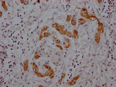 IHC image of RAC07519 diluted at 1:100 and staining in paraffin-embedded human pancreatic cancer performed on a Leica BondTM system. After dewaxing and hydration, antigen retrieval was mediated by high pressure in a citrate buffer (pH 6.0). Section was blocked with 10% normal goat serum 30min at RT. Then primary antibody (1% BSA) was incubated at 4? overnight. The primary is detected by a Goat anti-rabbit IgG polymer labeled by HRP and visualized using 0.05% DAB.