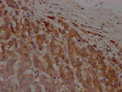 IHC image of RAC07523 diluted at 1:100 and staining in paraffin-embedded human breast cancer performed on a Leica BondTM system. After dewaxing and hydration, antigen retrieval was mediated by high pressure in a citrate buffer (pH 6.0). Section was blocked with 10% normal goat serum 30min at RT. Then primary antibody (1% BSA) was incubated at 4? overnight. The primary is detected by a Goat anti-rabbit IgG polymer labeled by HRP and visualized using 0.05% DAB.