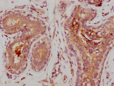 IHC image of RAC07524 diluted at 1:235 and staining in paraffin-embedded human breast cancer performed on a Leica BondTM system. After dewaxing and hydration, antigen retrieval was mediated by high pressure in a citrate buffer (pH 6.0). Section was blocked with 10% normal goat serum 30min at RT. Then primary antibody (1% BSA) was incubated at 4? overnight. The primary is detected by a biotinylated secondary antibody and visualized using an HRP conjugated SP system.