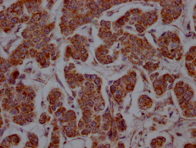 IHC image of RAC07527 diluted at 1:100 and staining in paraffin-embedded human breast cancer performed on a Leica BondTM system. After dewaxing and hydration, antigen retrieval was mediated by high pressure in a citrate buffer (pH 6.0). Section was blocked with 10% normal goat serum 30min at RT. Then primary antibody (1% BSA) was incubated at 4? overnight. The primary is detected by a Goat anti-rabbit IgG polymer labeled by HRP and visualized using 0.05% DAB.