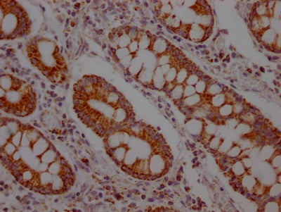 IHC image of RAC07527 diluted at 1:100 and staining in paraffin-embedded human colon cancer performed on a Leica BondTM system. After dewaxing and hydration, antigen retrieval was mediated by high pressure in a citrate buffer (pH 6.0). Section was blocked with 10% normal goat serum 30min at RT. Then primary antibody (1% BSA) was incubated at 4? overnight. The primary is detected by a Goat anti-rabbit IgG polymer labeled by HRP and visualized using 0.05% DAB.