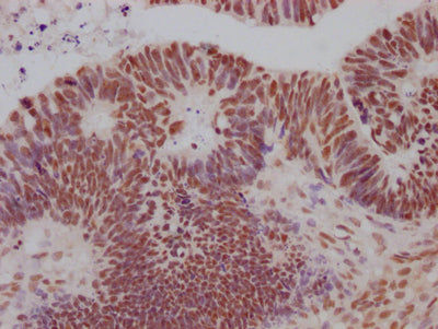 IHC image of RAC07529 diluted at 1:100 and staining in paraffin-embedded human ovarian cancer performed on a Leica BondTM system. After dewaxing and hydration, antigen retrieval was mediated by high pressure in a citrate buffer (pH 6.0). Section was blocked with 10% normal goat serum 30min at RT. Then primary antibody (1% BSA) was incubated at 4? overnight. The primary is detected by a Goat anti-rabbit IgG polymer labeled by HRP and visualized using 0.05% DAB.