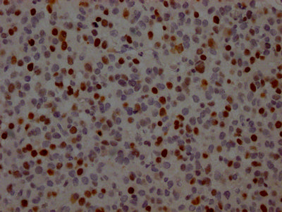 IHC image of RAC07531 diluted at 1:100 and staining in paraffin-embedded human glioma cancer performed on a Leica BondTM system. After dewaxing and hydration, antigen retrieval was mediated by high pressure in a citrate buffer (pH 6.0). Section was blocked with 10% normal goat serum 30min at RT. Then primary antibody (1% BSA) was incubated at 4? overnight. The primary is detected by a Goat anti-rabbit IgG polymer labeled by HRP and visualized using 0.05% DAB.