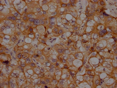 IHC image of RAC07536 diluted at 1:100 and staining in paraffin-embedded human liver cancer performed on a Leica BondTM system. After dewaxing and hydration, antigen retrieval was mediated by high pressure in a citrate buffer (pH 6.0). Section was blocked with 10% normal goat serum 30min at RT. Then primary antibody (1% BSA) was incubated at 4? overnight. The primary is detected by a Goat anti-rabbit IgG polymer labeled by HRP and visualized using 0.05% DAB.