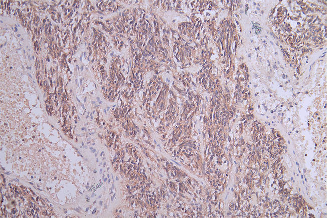IHC image of RAC07539 diluted at 1:100 and staining in paraffin-embedded human glioma cancer performed on a Leica BondTM system. After dewaxing and hydration, antigen retrieval was mediated by high pressure in a citrate buffer (pH 6.0). Section was blocked with 10% normal goat serum 30min at RT. Then primary antibody (1% BSA) was incubated at 4Â°C overnight. The primary is detected by a Goat anti-rabbit polymer IgG labeled by HRP and visualized using 0.05% DAB.