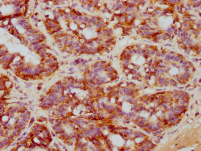 IHC image of RAC07540 diluted at 1:71.6666666666667 and staining in paraffin-embedded human breast cancer performed on a Leica BondTM system. After dewaxing and hydration, antigen retrieval was mediated by high pressure in a citrate buffer (pH 6.0). Section was blocked with 10% normal goat serum 30min at RT. Then primary antibody (1% BSA) was incubated at 4? overnight. The primary is detected by a biotinylated secondary antibody and visualized using an HRP conjugated SP system.