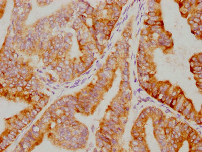 IHC image of RAC07546 diluted at 1:79.75 and staining in paraffin-embedded human endometrial cancer performed on a Leica BondTM system. After dewaxing and hydration, antigen retrieval was mediated by high pressure in a citrate buffer (pH 6.0). Section was blocked with 10% normal goat serum 30min at RT. Then primary antibody (1% BSA) was incubated at 4? overnight. The primary is detected by a biotinylated secondary antibody and visualized using an HRP conjugated SP system.