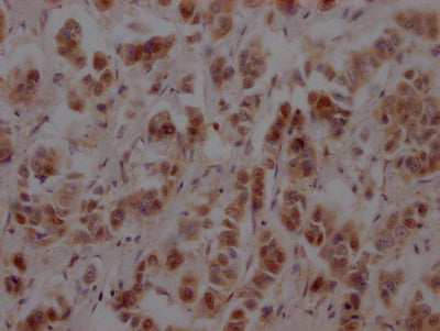 IHC image of RAC07560 diluted at 1:100 and staining in paraffin-embedded human breast cancer performed on a Leica BondTM system. After dewaxing and hydration, antigen retrieval was mediated by high pressure in a citrate buffer (pH 6.0). Section was blocked with 10% normal goat serum 30min at RT. Then primary antibody (1% BSA) was incubated at 4? overnight. The primary is detected by a Goat anti-rabbit IgG polymer labeled by HRP and visualized using 0.05% DAB.