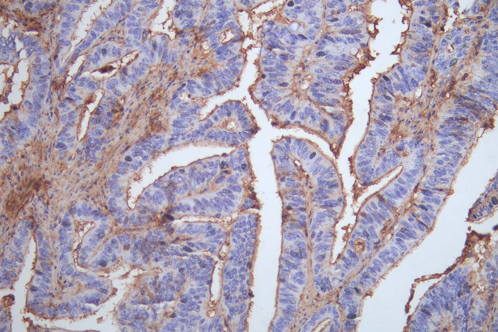 IHC image of RAC07561 diluted at 1:100 and staining in paraffin-embedded human colon cancer performed on a Leica BondTM system. After dewaxing and hydration, antigen retrieval was mediated by high pressure in a citrate buffer (pH 6.0). Section was blocked with 10% normal goat serum 30min at RT. Then primary antibody (1% BSA) was incubated at 4Â°C overnight. The primary is detected by a Goat anti-rabbit polymer IgG labeled by HRP and visualized using 0.05% DAB.