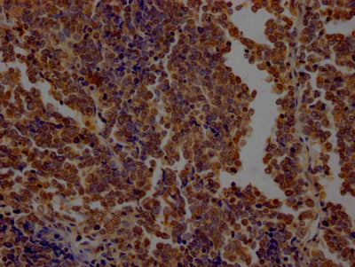 IHC image of RAC07562 diluted at 1:100 and staining in paraffin-embedded human lung cancer performed on a Leica BondTM system. After dewaxing and hydration, antigen retrieval was mediated by high pressure in a citrate buffer (pH 6.0). Section was blocked with 10% normal goat serum 30min at RT. Then primary antibody (1% BSA) was incubated at 4? overnight. The primary is detected by a Goat anti-rabbit IgG polymer labeled by HRP and visualized using 0.05% DAB.