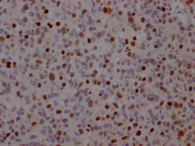 IHC image of RAC07569 diluted at 1:100 and staining in paraffin-embedded human glioma cancer performed on a Leica BondTM system. After dewaxing and hydration, antigen retrieval was mediated by high pressure in a citrate buffer (pH 6.0). Section was blocked with 10% normal goat serum 30min at RT. Then primary antibody (1% BSA) was incubated at 4? overnight. The primary is detected by a Goat anti-rabbit IgG polymer labeled by HRP and visualized using 0.05% DAB.