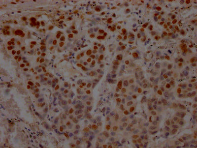 IHC image of RAC07571 diluted at 1:100 and staining in paraffin-embedded human breast cancer performed on a Leica BondTM system. After dewaxing and hydration, antigen retrieval was mediated by high pressure in a citrate buffer (pH 6.0). Section was blocked with 10% normal goat serum 30min at RT. Then primary antibody (1% BSA) was incubated at 4? overnight. The primary is detected by a Goat anti-rabbit IgG polymer labeled by HRP and visualized using 0.05% DAB.
