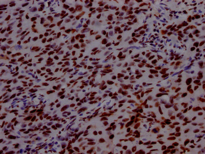 IHC image of RAC07573 diluted at 1:100 and staining in paraffin-embedded human bladder cancer performed on a Leica BondTM system. After dewaxing and hydration, antigen retrieval was mediated by high pressure in a citrate buffer (pH 6.0). Section was blocked with 10% normal goat serum 30min at RT. Then primary antibody (1% BSA) was incubated at 4? overnight. The primary is detected by a Goat anti-rabbit IgG polymer labeled by HRP and visualized using 0.05% DAB.