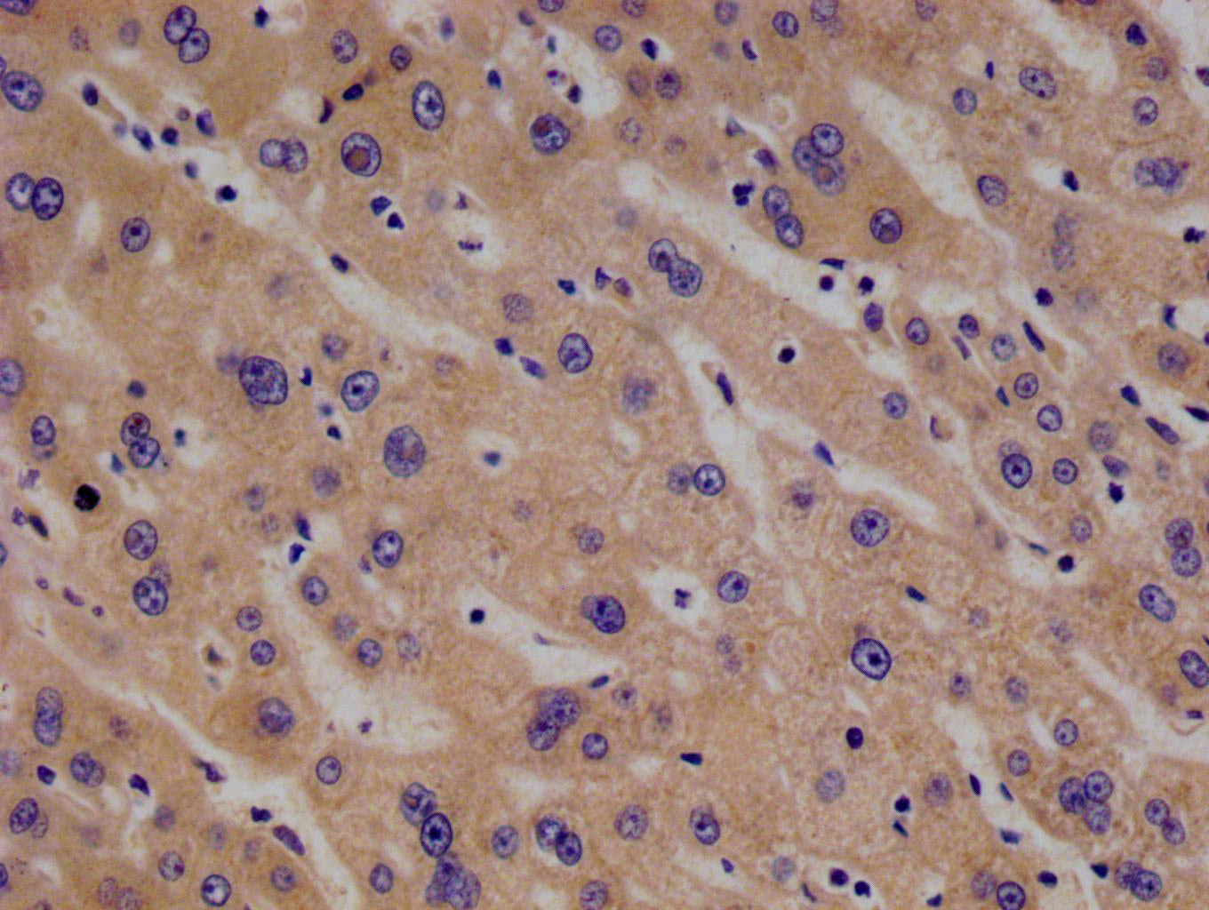 IHC image of RAC07574 diluted at 1:100 and staining in paraffin-embedded human liver cancer performed on a Leica BondTM system. After dewaxing and hydration, antigen retrieval was mediated by high pressure in a citrate buffer (pH 6.0). Section was blocked with 10% normal goat serum 30min at RT. Then primary antibody (1% BSA) was incubated at 4Â°C overnight. The primary is detected by a Goat anti-rabbit polymer IgG labeled by HRP and visualized using 0.05% DAB.