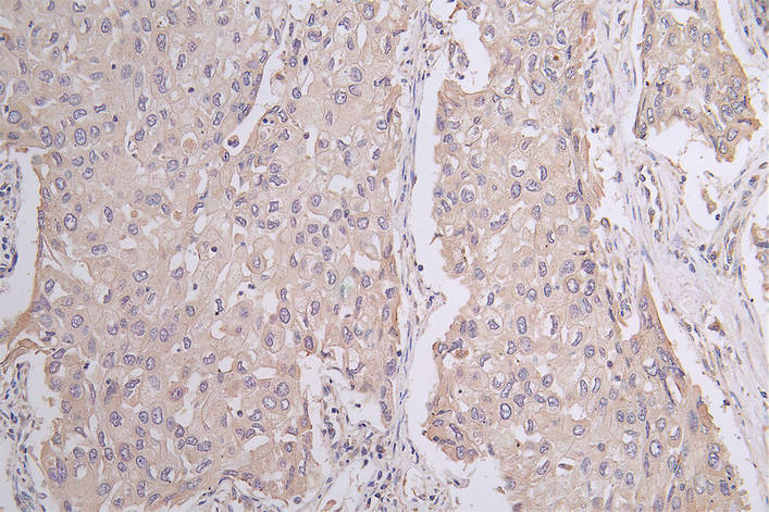 IHC image of RAC07578 diluted at 1:50 and staining in paraffin-embedded human lung cancer performed on a Leica BondTM system. After dewaxing and hydration, antigen retrieval was mediated by high pressure in a citrate buffer (pH 6.0). Section was blocked with 10% normal goat serum 30min at RT. Then primary antibody (1% BSA) was incubated at 4Â°C overnight. The primary is detected by a Goat anti-rabbit polymer IgG labeled by HRP and visualized using 0.1:50% DAB.