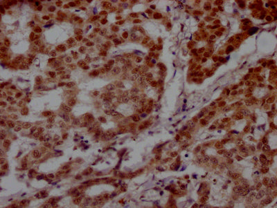 IHC image of RAC07580 diluted at 1:100 and staining in paraffin-embedded human breast cancer performed on a Leica BondTM system. After dewaxing and hydration, antigen retrieval was mediated by high pressure in a citrate buffer (pH 6.0). Section was blocked with 10% normal goat serum 30min at RT. Then primary antibody (1% BSA) was incubated at 4? overnight. The primary is detected by a Goat anti-rabbit IgG polymer labeled by HRP and visualized using 0.05% DAB.