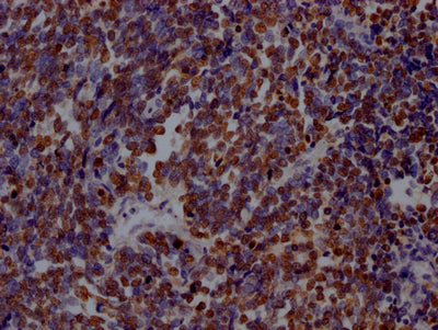 IHC image of RAC07580 diluted at 1:100 and staining in paraffin-embedded human lung cancer performed on a Leica BondTM system. After dewaxing and hydration, antigen retrieval was mediated by high pressure in a citrate buffer (pH 6.0). Section was blocked with 10% normal goat serum 30min at RT. Then primary antibody (1% BSA) was incubated at 4? overnight. The primary is detected by a Goat anti-rabbit IgG polymer labeled by HRP and visualized using 0.05% DAB.