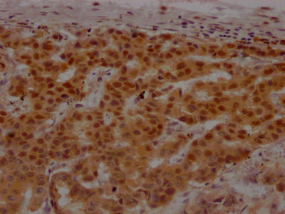 IHC image of RAC07581 diluted at 1:100 and staining in paraffin-embedded human breast cancer performed on a Leica BondTM system. After dewaxing and hydration, antigen retrieval was mediated by high pressure in a citrate buffer (pH 6.0). Section was blocked with 10% normal goat serum 30min at RT. Then primary antibody (1% BSA) was incubated at 4? overnight. The primary is detected by a Goat anti-rabbit IgG polymer labeled by HRP and visualized using 0.05% DAB.