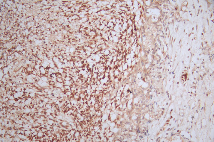 IHC image of RAC07582 diluted at 1:100 and staining in paraffin-embedded human glioma cancer performed on a Leica BondTM system. After dewaxing and hydration, antigen retrieval was mediated by high pressure in a citrate buffer (pH 6.0). Section was blocked with 10% normal goat serum 30min at RT. Then primary antibody (1% BSA) was incubated at 4Â°C overnight. The primary is detected by a Goat anti-rabbit polymer IgG labeled by HRP and visualized using 0.55% DAB.