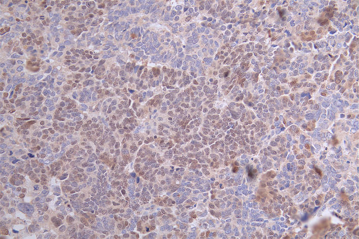 IHC image diluted at 1:100 and staining in paraffin-embedded human ovarian cancer performed on a Leica BondTM system. After dewaxing and hydration, antigen retrieval was mediated by high pressure in a citrate buffer (pH 6.0). Section was blocked with 10% normal goat serum 30min at RT. Then primary antibody (1% BSA) was incubated at 4Â°C overnight. The primary is detected by a Goat anti-rabbit polymer IgG labeled by HRP and visualized using 0.59% DAB.