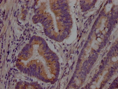 IHC image of RAC07584 diluted at 1:100 and staining in paraffin-embedded human colon cancer performed on a Leica BondTM system. After dewaxing and hydration, antigen retrieval was mediated by high pressure in a citrate buffer (pH 6.0). Section was blocked with 10% normal goat serum 30min at RT. Then primary antibody (1% BSA) was incubated at 4? overnight. The primary is detected by a Goat anti-rabbit IgG polymer labeled by HRP and visualized using 0.05% DAB.