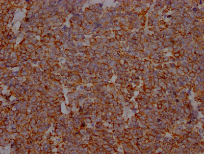 IHC image of RAC07590 diluted at 1:100 and staining in paraffin-embedded human lung cancer performed on a Leica BondTM system. After dewaxing and hydration, antigen retrieval was mediated by high pressure in a citrate buffer (pH 6.0). Section was blocked with 10% normal goat serum 30min at RT. Then primary antibody (1% BSA) was incubated at 4? overnight. The primary is detected by a Goat anti-rabbit IgG polymer labeled by HRP and visualized using 0.05% DAB.
