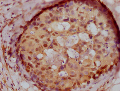 IHC image of RAC07592 diluted at 1:100 and staining in paraffin-embedded human breast cancer performed on a Leica BondTM system. After dewaxing and hydration, antigen retrieval was mediated by high pressure in a citrate buffer (pH 6.0). Section was blocked with 10% normal goat serum 30min at RT. Then primary antibody (1% BSA) was incubated at 4? overnight. The primary is detected by a Goat anti-rabbit IgG polymer labeled by HRP and visualized using 0.05% DAB.