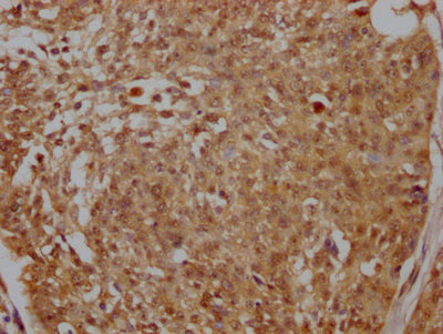 IHC image of RAC07592 diluted at 1:100 and staining in paraffin-embedded human cervical cancer performed on a Leica BondTM system. After dewaxing and hydration, antigen retrieval was mediated by high pressure in a citrate buffer (pH 6.0). Section was blocked with 10% normal goat serum 30min at RT. Then primary antibody (1% BSA) was incubated at 4? overnight. The primary is detected by a Goat anti-rabbit IgG polymer labeled by HRP and visualized using 0.05% DAB.