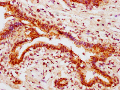 IHC image of RAC07594 diluted at 1:100 and staining in paraffin-embedded human breast cancer performed on a Leica BondTM system. After dewaxing and hydration, antigen retrieval was mediated by high pressure in a citrate buffer (pH 6.0). Section was blocked with 10% normal goat serum 30min at RT. Then primary antibody (1% BSA) was incubated at 4? overnight. The primary is detected by a biotinylated secondary antibody and visualized using an HRP conjugated SP system.