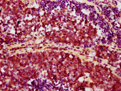 IHC image of RAC07594 diluted at 1:100 and staining in paraffin-embedded human lung cancer performed on a Leica BondTM system. After dewaxing and hydration, antigen retrieval was mediated by high pressure in a citrate buffer (pH 6.0). Section was blocked with 10% normal goat serum 30min at RT. Then primary antibody (1% BSA) was incubated at 4? overnight. The primary is detected by a biotinylated secondary antibody and visualized using an HRP conjugated SP system.