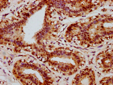 IHC image of RAC07600 diluted at 1:100 and staining in paraffin-embedded human breast cancer performed on a Leica BondTM system. After dewaxing and hydration, antigen retrieval was mediated by high pressure in a citrate buffer (pH 6.0). Section was blocked with 10% normal goat serum 30min at RT. Then primary antibody (1% BSA) was incubated at 4? overnight. The primary is detected by a biotinylated secondary antibody and visualized using an HRP conjugated SP system.