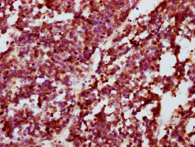 IHC image of RAC07600 diluted at 1:100 and staining in paraffin-embedded human lung cancer performed on a Leica BondTM system. After dewaxing and hydration, antigen retrieval was mediated by high pressure in a citrate buffer (pH 6.0). Section was blocked with 10% normal goat serum 30min at RT. Then primary antibody (1% BSA) was incubated at 4? overnight. The primary is detected by a biotinylated secondary antibody and visualized using an HRP conjugated SP system.