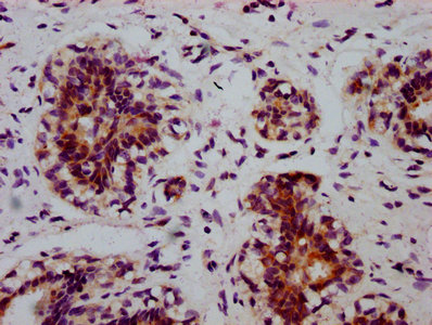 IHC image of RAC07604 diluted at 1:100 and staining in paraffin-embedded human breast cancer performed on a Leica BondTM system. After dewaxing and hydration, antigen retrieval was mediated by high pressure in a citrate buffer (pH 6.0). Section was blocked with 10% normal goat serum 30min at RT. Then primary antibody (1% BSA) was incubated at 4? overnight. The primary is detected by a biotinylated secondary antibody and visualized using an HRP conjugated SP system.
