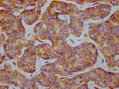 IHC image of RAC07604 diluted at 1:100 and staining in paraffin-embedded human liver cancer performed on a Leica BondTM system. After dewaxing and hydration, antigen retrieval was mediated by high pressure in a citrate buffer (pH 6.0). Section was blocked with 10% normal goat serum 30min at RT. Then primary antibody (1% BSA) was incubated at 4? overnight. The primary is detected by a biotinylated secondary antibody and visualized using an HRP conjugated SP system.