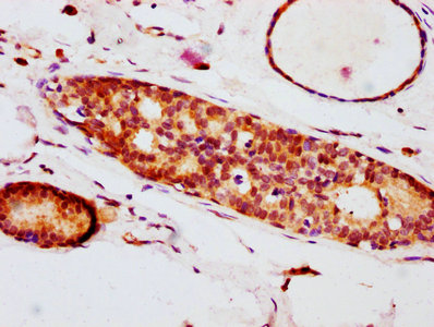 IHC image of RAC07605 diluted at 1:100 and staining in paraffin-embedded human breast cancer performed on a Leica BondTM system. After dewaxing and hydration, antigen retrieval was mediated by high pressure in a citrate buffer (pH 6.0). Section was blocked with 10% normal goat serum 30min at RT. Then primary antibody (1% BSA) was incubated at 4? overnight. The primary is detected by a biotinylated secondary antibody and visualized using an HRP conjugated SP system.