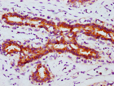 IHC image of RAC07607 diluted at 1:100 and staining in paraffin-embedded human breast cancer performed on a Leica BondTM system. After dewaxing and hydration, antigen retrieval was mediated by high pressure in a citrate buffer (pH 6.0). Section was blocked with 10% normal goat serum 30min at RT. Then primary antibody (1% BSA) was incubated at 4? overnight. The primary is detected by a biotinylated secondary antibody and visualized using an HRP conjugated SP system.