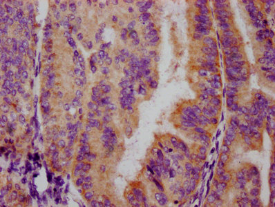 IHC image of RAC07607 diluted at 1:100 and staining in paraffin-embedded human endometrial cancer performed on a Leica BondTM system. After dewaxing and hydration, antigen retrieval was mediated by high pressure in a citrate buffer (pH 6.0). Section was blocked with 10% normal goat serum 30min at RT. Then primary antibody (1% BSA) was incubated at 4? overnight. The primary is detected by a biotinylated secondary antibody and visualized using an HRP conjugated SP system.