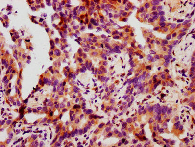 IHC image of RAC07612 diluted at 1:100 and staining in paraffin-embedded human lung cancer performed on a Leica BondTM system. After dewaxing and hydration, antigen retrieval was mediated by high pressure in a citrate buffer (pH 6.0). Section was blocked with 10% normal goat serum 30min at RT. Then primary antibody (1% BSA) was incubated at 4? overnight. The primary is detected by a biotinylated secondary antibody and visualized using an HRP conjugated SP system.