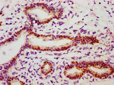 IHC image of RAC07612 diluted at 1:100 and staining in paraffin-embedded human breast cancer performed on a Leica BondTM system. After dewaxing and hydration, antigen retrieval was mediated by high pressure in a citrate buffer (pH 6.0). Section was blocked with 10% normal goat serum 30min at RT. Then primary antibody (1% BSA) was incubated at 4? overnight. The primary is detected by a biotinylated secondary antibody and visualized using an HRP conjugated SP system.