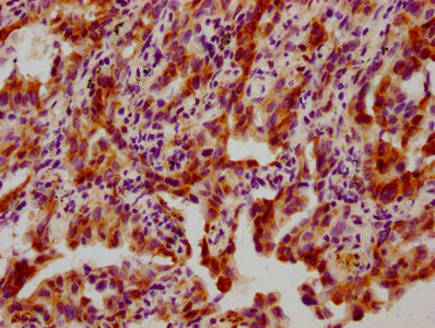 IHC image of RAC07613 diluted at 1:100 and staining in paraffin-embedded human lung cancer performed on a Leica BondTM system. After dewaxing and hydration, antigen retrieval was mediated by high pressure in a citrate buffer (pH 6.0). Section was blocked with 10% normal goat serum 30min at RT. Then primary antibody (1% BSA) was incubated at 4? overnight. The primary is detected by a biotinylated secondary antibody and visualized using an HRP conjugated SP system.