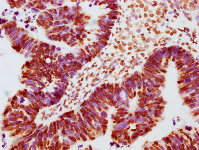 IHC image of RAC07615 diluted at 1:100 and staining in paraffin-embedded human ovarian cancer performed on a Leica BondTM system. After dewaxing and hydration, antigen retrieval was mediated by high pressure in a citrate buffer (pH 6.0). Section was blocked with 10% normal goat serum 30min at RT. Then primary antibody (1% BSA) was incubated at 4? overnight. The primary is detected by a biotinylated secondary antibody and visualized using an HRP conjugated SP system.