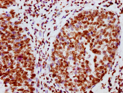 IHC image of RAC07615 diluted at 1:100 and staining in paraffin-embedded human cervical cancer performed on a Leica BondTM system. After dewaxing and hydration, antigen retrieval was mediated by high pressure in a citrate buffer (pH 6.0). Section was blocked with 10% normal goat serum 30min at RT. Then primary antibody (1% BSA) was incubated at 4? overnight. The primary is detected by a biotinylated secondary antibody and visualized using an HRP conjugated SP system.