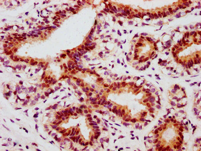 IHC image of RAC07616 diluted at 1:100 and staining in paraffin-embedded human breast cancer performed on a Leica BondTM system. After dewaxing and hydration, antigen retrieval was mediated by high pressure in a citrate buffer (pH 6.0). Section was blocked with 10% normal goat serum 30min at RT. Then primary antibody (1% BSA) was incubated at 4Â°C overnight. The primary is detected by a biotinylated secondary antibody and visualized using an HRP conjugated SP system.