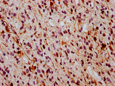 IHC image of RAC07618 diluted at 1:100 and staining in paraffin-embedded human glioma cancer performed on a Leica BondTM system. After dewaxing and hydration, antigen retrieval was mediated by high pressure in a citrate buffer (pH 6.0). Section was blocked with 10% normal goat serum 30min at RT. Then primary antibody (1% BSA) was incubated at 4? overnight. The primary is detected by a biotinylated secondary antibody and visualized using an HRP conjugated SP system.