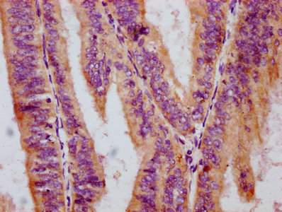 IHC image of RAC07642 diluted at 1:100 and staining in paraffin-embedded human endometrial cancer performed on a Leica BondTM system. After dewaxing and hydration, antigen retrieval was mediated by high pressure in a citrate buffer (pH 6.0). Section was blocked with 10% normal goat serum 30min at RT. Then primary antibody (1% BSA) was incubated at 4? overnight. The primary is detected by a biotinylated secondary antibody and visualized using an HRP conjugated SP system.