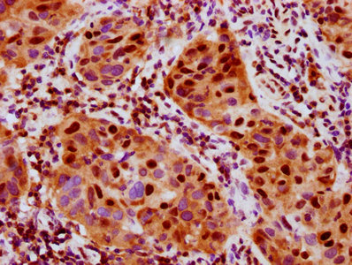 IHC image of RAC07649 diluted at 1:100 and staining in paraffin-embedded human bladder cancer performed on a Leica BondTM system. After dewaxing and hydration, antigen retrieval was mediated by high pressure in a citrate buffer (pH 6.0). Section was blocked with 10% normal goat serum 30min at RT. Then primary antibody (1% BSA) was incubated at 4? overnight. The primary is detected by a biotinylated secondary antibody and visualized using an HRP conjugated SP system.