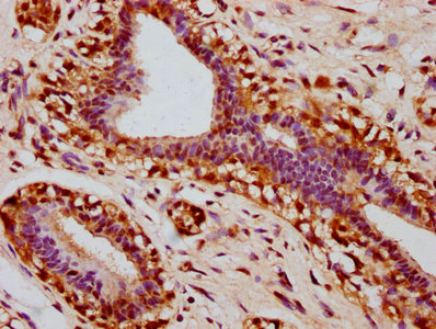 IHC image of RAC07657 diluted at 1:100 and staining in paraffin-embedded human breast cancer performed on a Leica BondTM system. After dewaxing and hydration, antigen retrieval was mediated by high pressure in a citrate buffer (pH 6.0). Section was blocked with 10% normal goat serum 30min at RT. Then primary antibody (1% BSA) was incubated at 4? overnight. The primary is detected by a biotinylated secondary antibody and visualized using an HRP conjugated SP system.