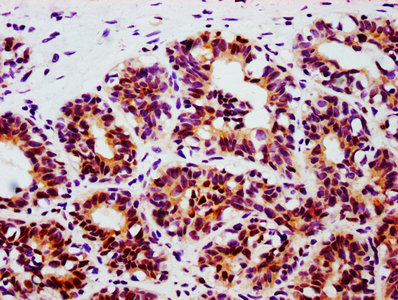 IHC image of RAC07658 diluted at 1:100 and staining in paraffin-embedded human breast cancer performed on a Leica BondTM system. After dewaxing and hydration, antigen retrieval was mediated by high pressure in a citrate buffer (pH 6.0). Section was blocked with 10% normal goat serum 30min at RT. Then primary antibody (1% BSA) was incubated at 4? overnight. The primary is detected by a biotinylated secondary antibody and visualized using an HRP conjugated SP system.