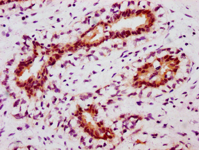IHC image of RAC07659 diluted at 1:100 and staining in paraffin-embedded human breast cancer performed on a Leica BondTM system. After dewaxing and hydration, antigen retrieval was mediated by high pressure in a citrate buffer (pH 6.0). Section was blocked with 10% normal goat serum 30min at RT. Then primary antibody (1% BSA) was incubated at 4? overnight. The primary is detected by a biotinylated secondary antibody and visualized using an HRP conjugated SP system.